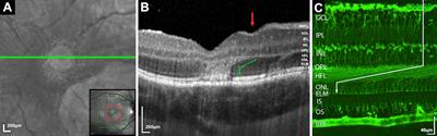 Proposing a Neurotropic Etiology for Acute Posterior Multifocal Placoid Pigment Epitheliopathy and Relentless Placoid Chorioretinitis